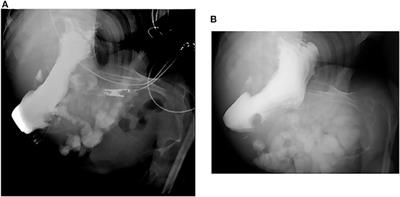 Cecal Intussusception Diagnosed by Total Colonoscopy in a Child: A Case Report